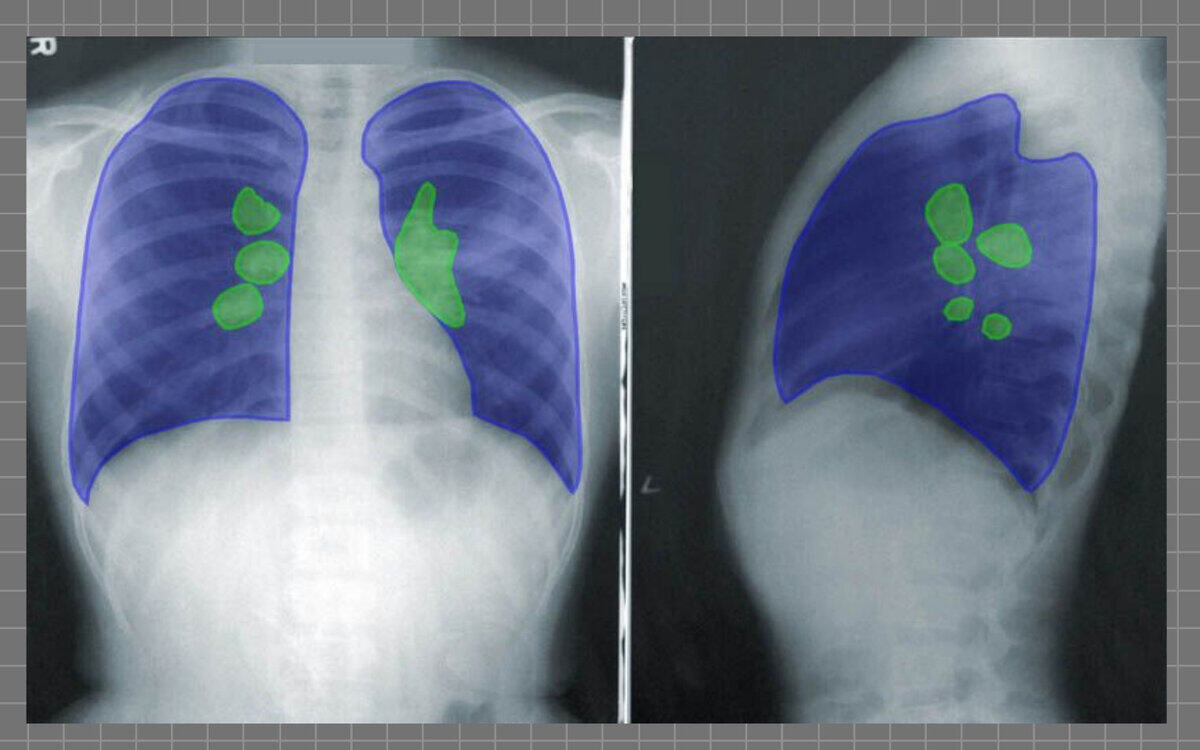 medical annotation lung view, front and side view